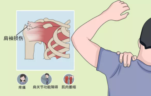 肩袖损伤怎么治疗最佳图片
